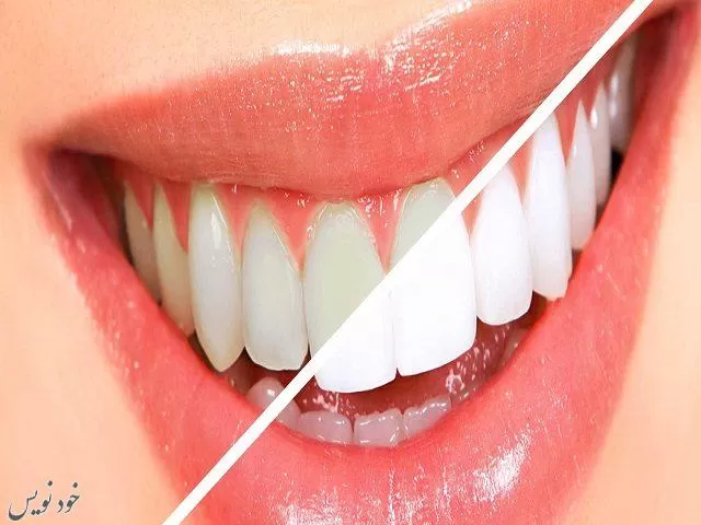 روش های طبیعی سفید کردن دندان ها | چرایی