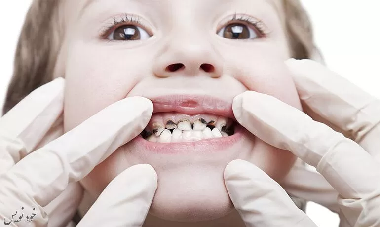 آسیب به دندانهای کودکان