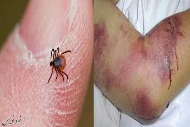 فوت دومین بیمار مبتلا به تب کریمه کنگو در ایران | افزایش آمار جانباختگان به ۱۸ نفر |اخبار حوادث