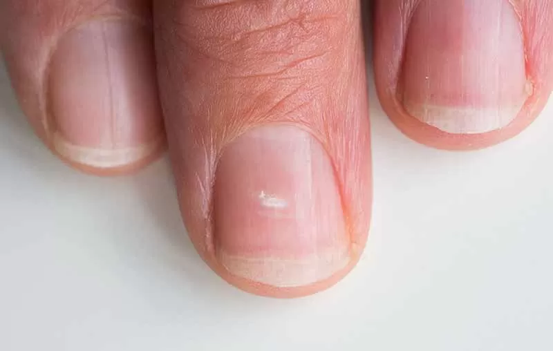 لکه های سفید روی ناخن به چه علت است؟| درمان