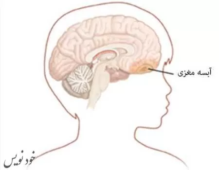 آبسه مغزی یا اپی دوال چیست ؟+ درمان . پیشگیری و علت 
