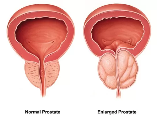 التهاب پروستات چیست و چگونه درمان می شود + علائم و روش تشخیص