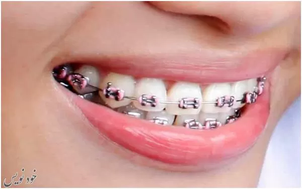 اهمیت بهداشت دهان در طی درمان ارتودنسی