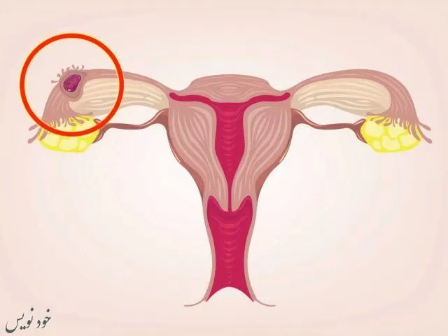 حاملگی خارج رحمی (ectopic pregnancy) چیست ؟