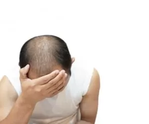 یکی از عوامل ریزش مو در مردان ژنتیک است