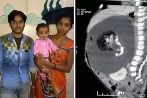 زایمان عجیب کودک 7 ماهه ای که باردار بود! + تصاویر 16+