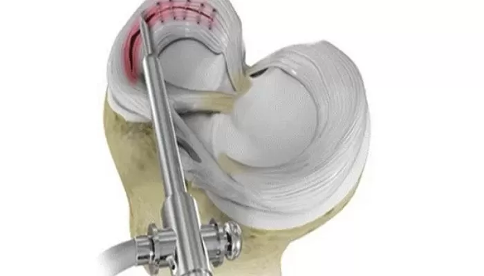 درمان مینیسک