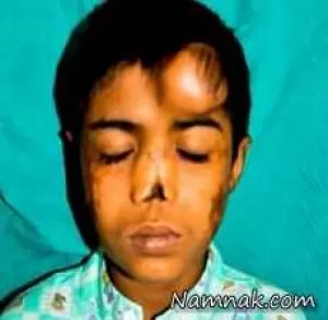 پیوند بینی | کاشت و پیوند بینی پسربچه هندی بعد از 12 سال