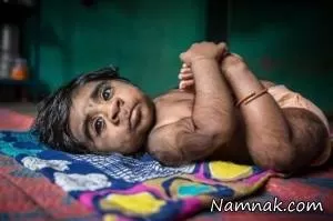 بیماری سندرم گرگ نمای پسر بچه هندی + عکس