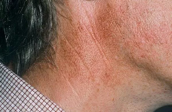 acanthosis nigricans