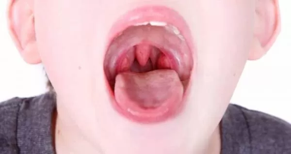 ورم یک طرفه لوزه