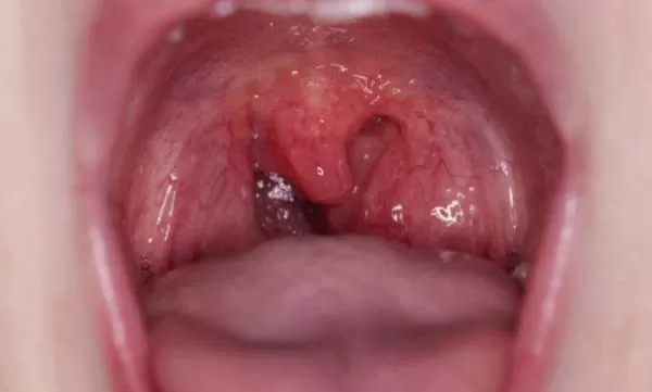 تونسیلیت مزمن