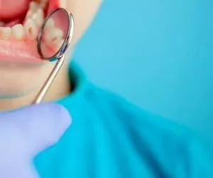 تمام علل و علائم پوسیدگی دندان + راههای پیشگیری و درمان