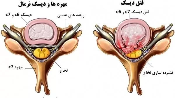 علل فتق دیسک بین مهره ای