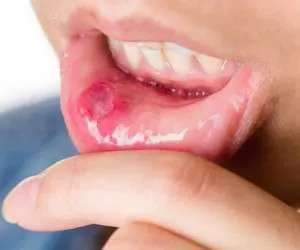 درمان “آفت دهان کودکان” و درمان های طب سنتی برای بهبود آفت دهان