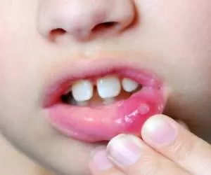 علت های مهم آفت دهان و زبان و روش های مختلف درمان آفت دهان