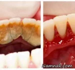 تارتار و پلاک دندان چگونه رفع می شود؟ +7 نسخه خانگی