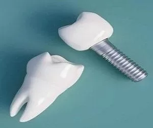 ایمپلنت دندان چیست و چگونه است ؟