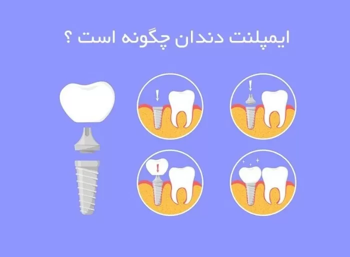 ایمپلنت کردن دندان