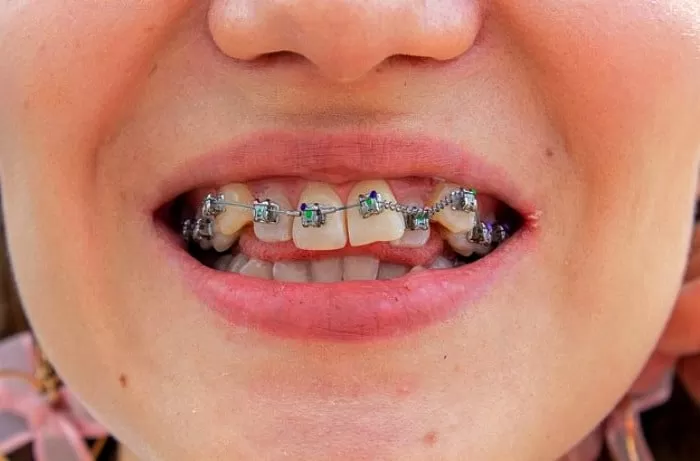 ارتودنسی دندان کودک