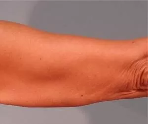 درمان طبیعی شلی و افتادگی پوست بازو و بدن در خانه 