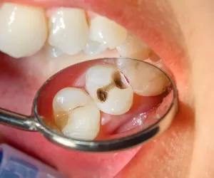 عوارض جدی عفونت دهان و دندان + بیماری ها