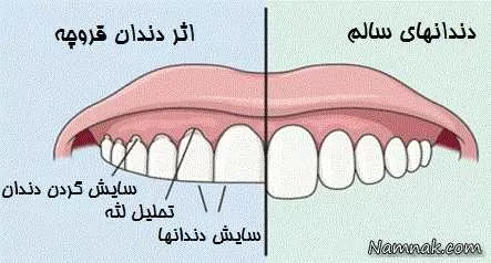 مشکلات دندان قروچه