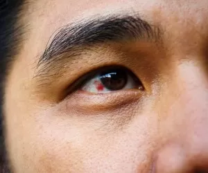 علل اصلی لکه خون در چشم و 8 درمان خانگی خونریزی زیر ملتحمه چشم