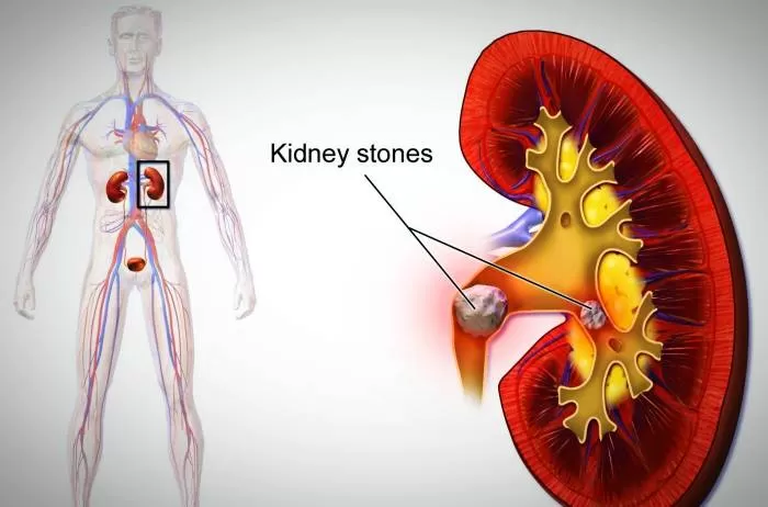 خطر سنگ کلیه