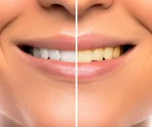 سفید کردن دندان با بیلیچینگ بهتره یا لامینت؟