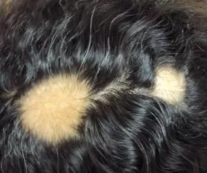 علل و علائم کچلی سکه ای و ریزش موی آلوپسی آره آتا + درمان ها