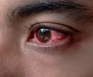 علت خشکی و قرمزی چشم و درمان آن