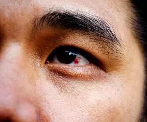 اصلی ترین علل قرمزی چشم و راه درمان آنها