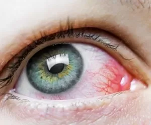 14 درمان عالی و کاربردی برای از بین بردن قرمز شدن چشم