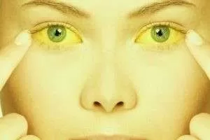 از علت و علائم تا 11 درمان گیاهی زردی چشم یا سندرم ژیلبرت
