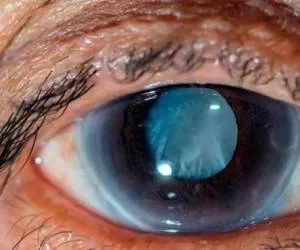 علل و علائم بیماری گکلوم و راههای درمان و پیشگیری از آب سیاه چشم