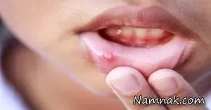 کدام زخم های دهان سرطانی هستند؟