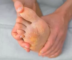 درمان سریع و طبیعی پای ورزشکار با جوش شیرین