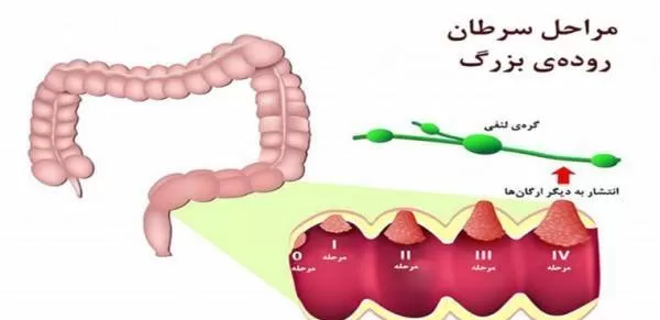 سرطان روده بزرگ