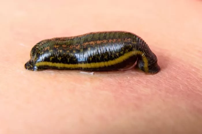 leech therapy