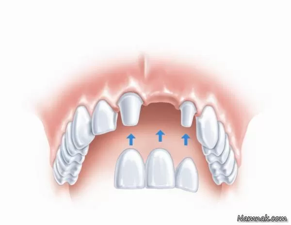 انواع پروتز ثابت دندان