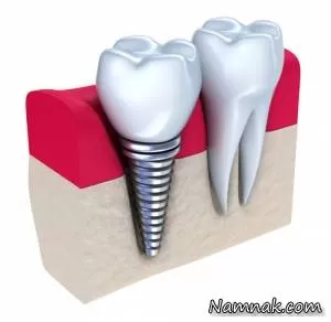 ایمپلنت دندان | راهنمای کامل و معرفی کامل انواع ایمپلنت