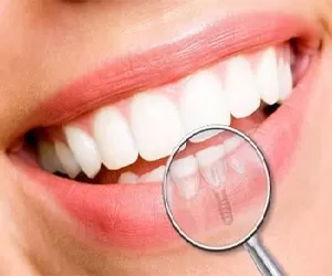 بهترین سن برای ایمپلنت دندان چیست؟