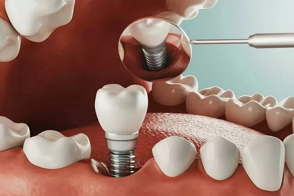 ایمپلنت کردن دندان