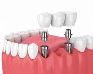 8نکته اساسی درباره کاشت دندان