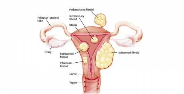 روش تشخیص فیبروئیدهای رحمی