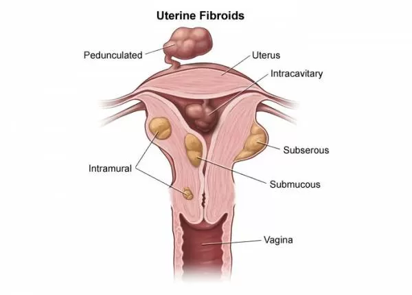 درمان های فیبروم رحم