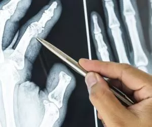 علائم و درمان شکستگی استخوان انگشت + نکات