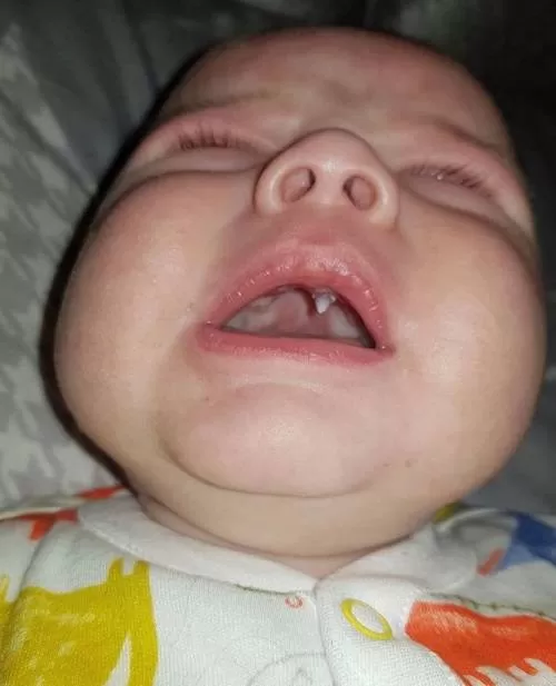 دندان نوزاد 3 ماهه