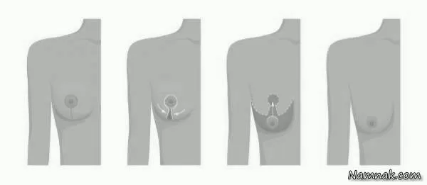  انواع جراحی لیفت سینه